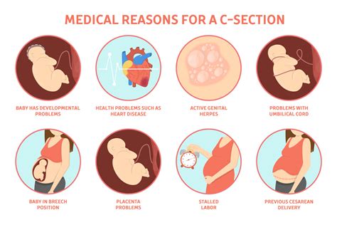 What Causes Low Blood Pressure During C Section